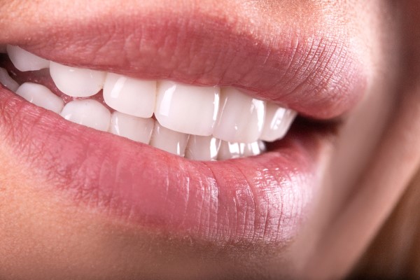 Dental Veneers Are A Solution For Chipped Teeth
