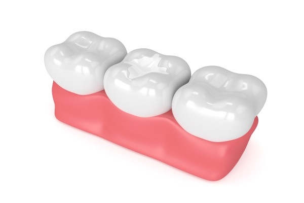 Is a Dental Filling Permanent? - Ortega Dental Care San Juan