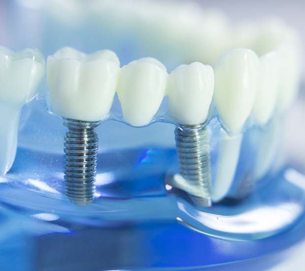 Is a Dental Filling Permanent? - Ortega Dental Care San Juan Capistrano  California
